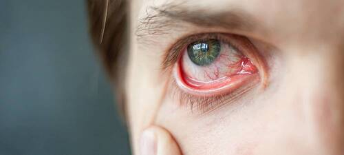 Причины появления красных глаз